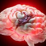 Safe Brain Hemorrhage Treatment by Specialists