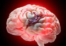 Safe Brain Hemorrhage Treatment by Specialists