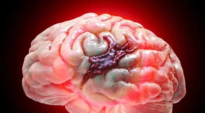 Safe Brain Hemorrhage Treatment by Specialists